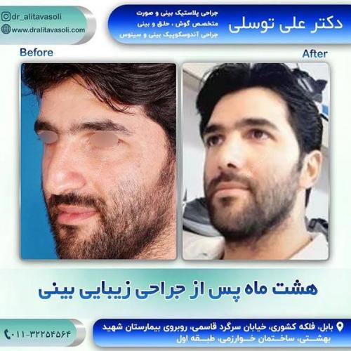جراحی-بینی315
