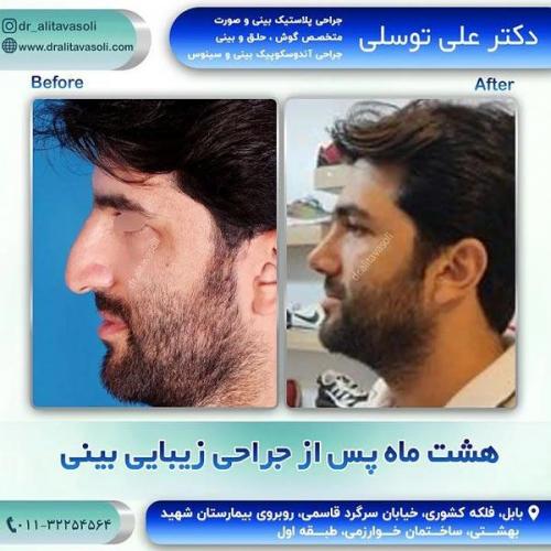 جراحی-بینی316