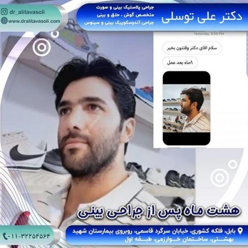 جراحی-بینی317