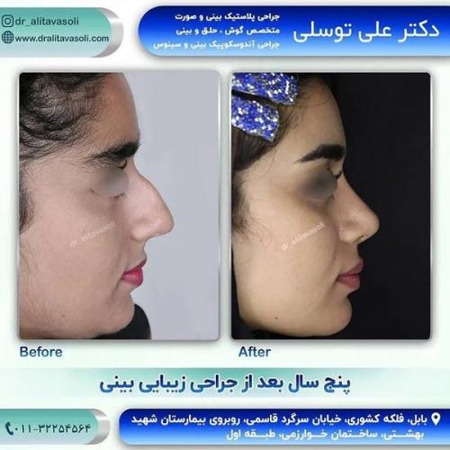 جراحی-بینی320