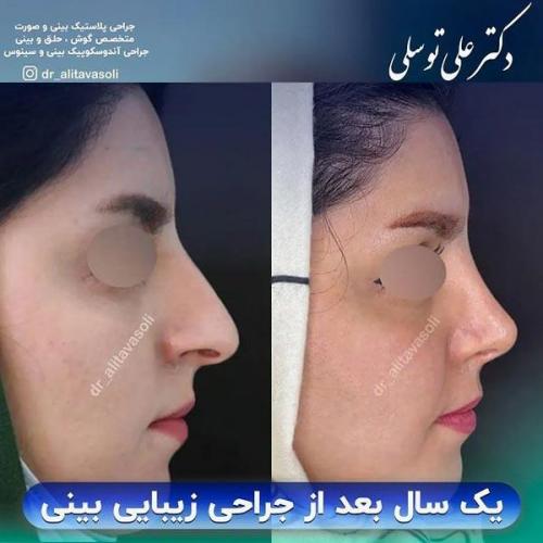 جراحی-بینی322