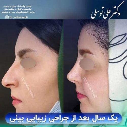 جراحی-بینی323