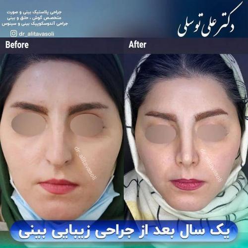 جراحی-بینی324-