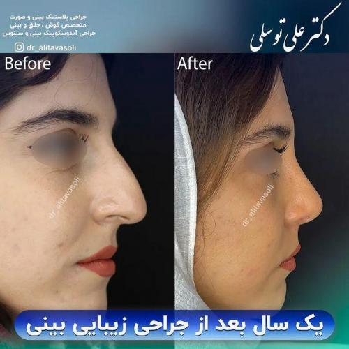 جراحی-بینی340
