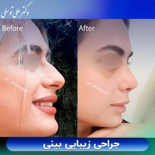 جراحی-بینی398