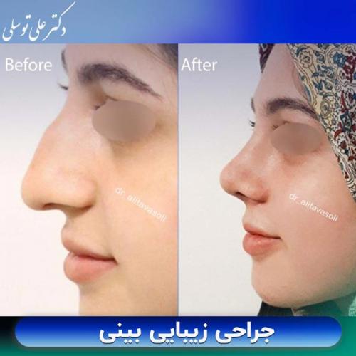 جراحی-بینی399