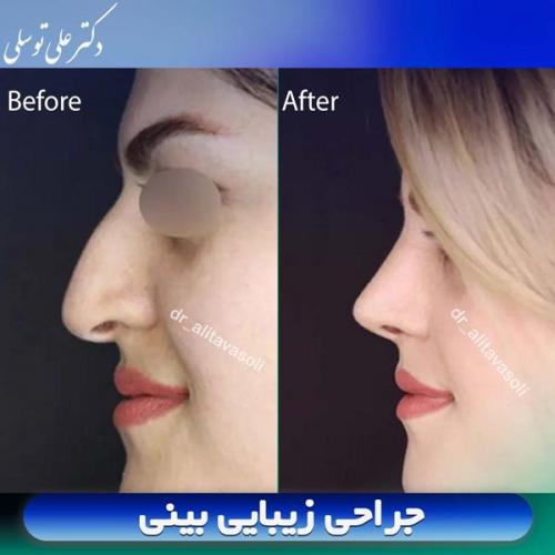 جراحی-بینی405