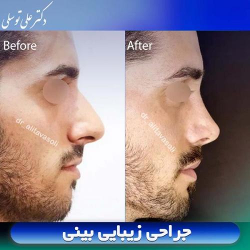 جراحی-بینی406