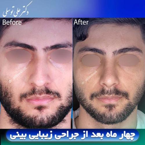 جراحی-بینی411