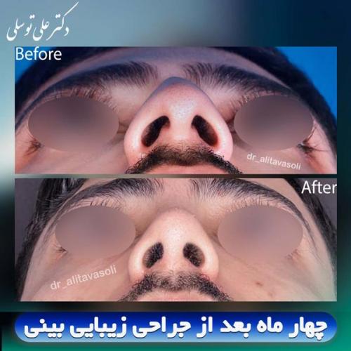 جراحی-بینی414
