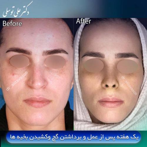 جراحی-بینی415