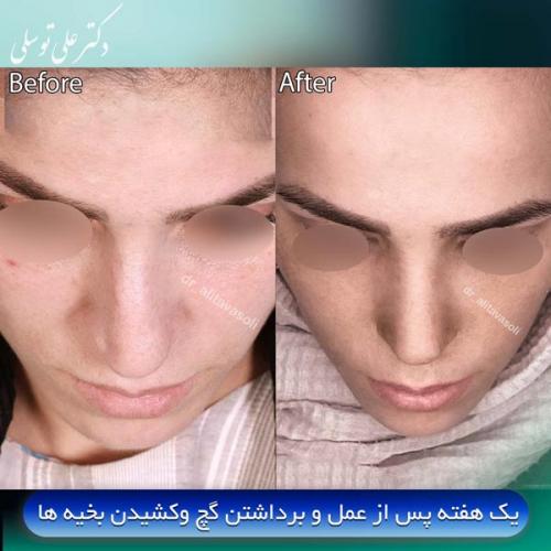 جراحی-بینی416