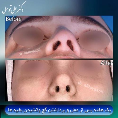 جراحی-بینی418