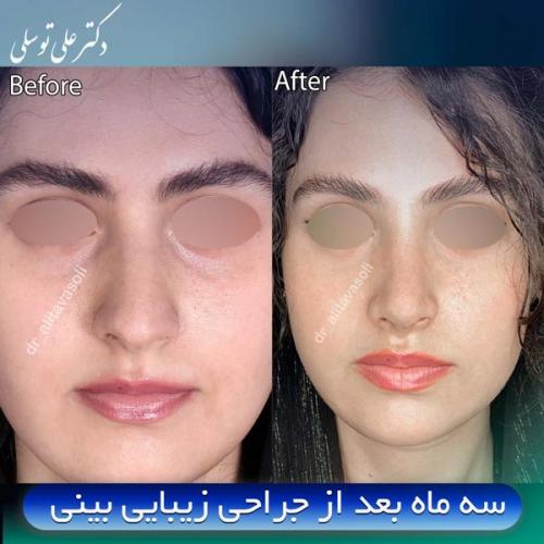 جراحی-بینی420