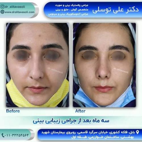جراحی بینی 150 (1)