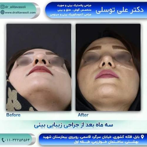 جراحی بینی 150 (10)