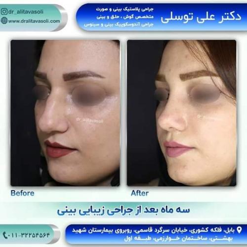 جراحی بینی 150 (13)