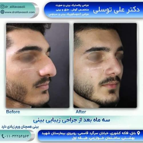جراحی بینی 150 (15)