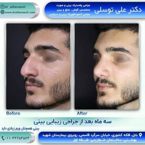 جراحی بینی 150 (16)
