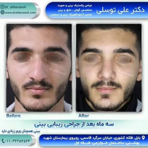 جراحی بینی 150 (17)