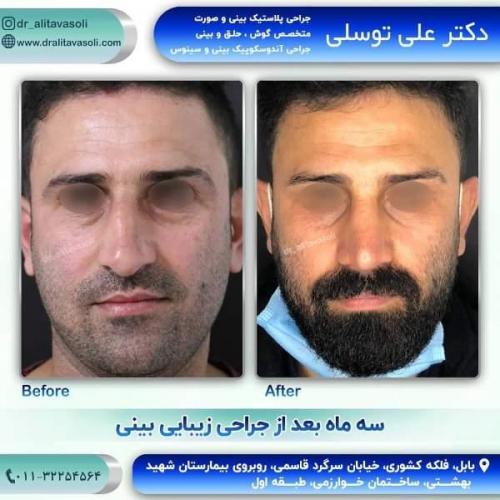 جراحی بینی 150 (18)