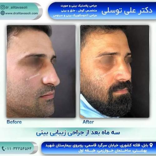 جراحی بینی 150 (20)