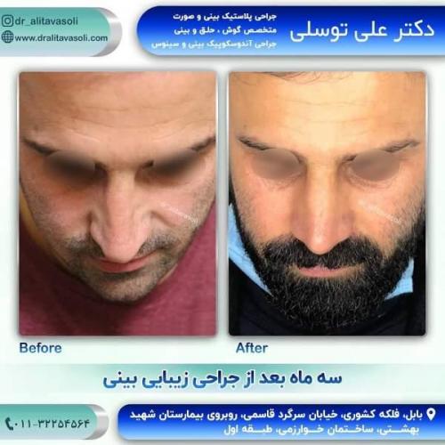 جراحی بینی 150 (22)