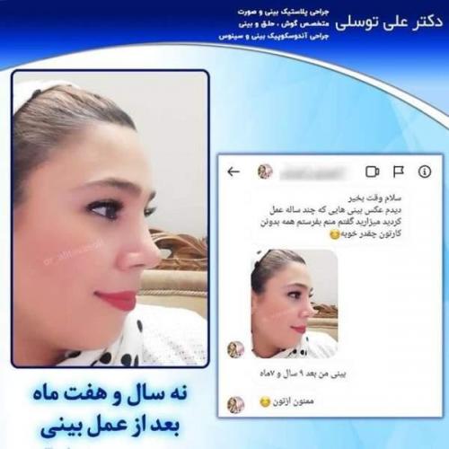 جراحی بینی 150 (24)