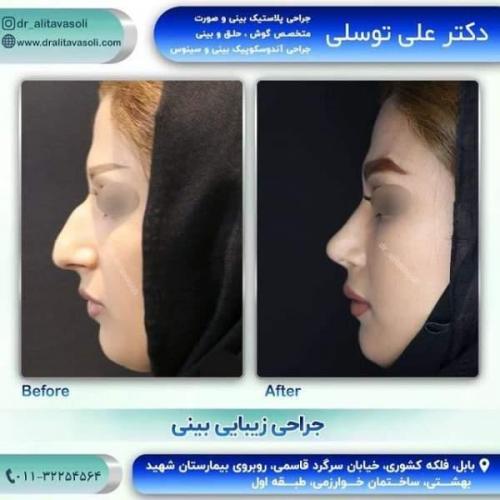 جراحی بینی 150 (26)