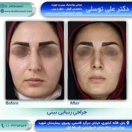 جراحی بینی 150 (27)