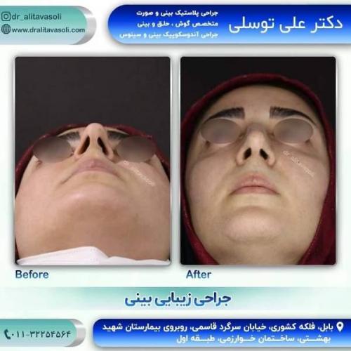 جراحی بینی 150 (28)