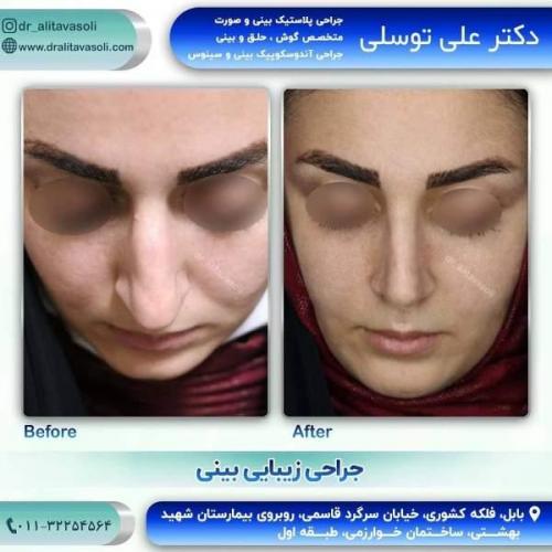 جراحی بینی 150 (29)
