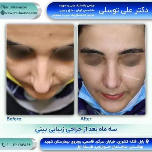 جراحی بینی 150 (3)
