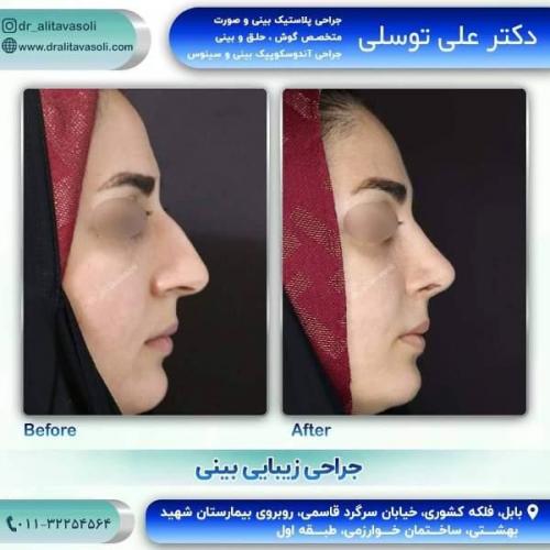 جراحی بینی 150 (30)