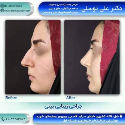 جراحی بینی 150 (31)