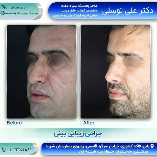 جراحی بینی 150 (32)