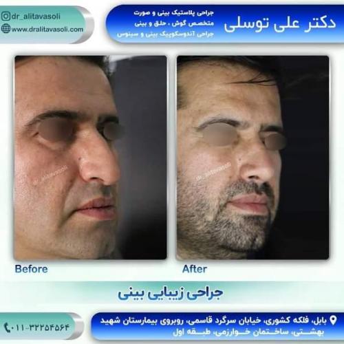 جراحی بینی 150 (33)