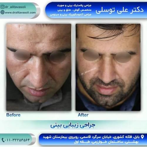 جراحی بینی 150 (34)