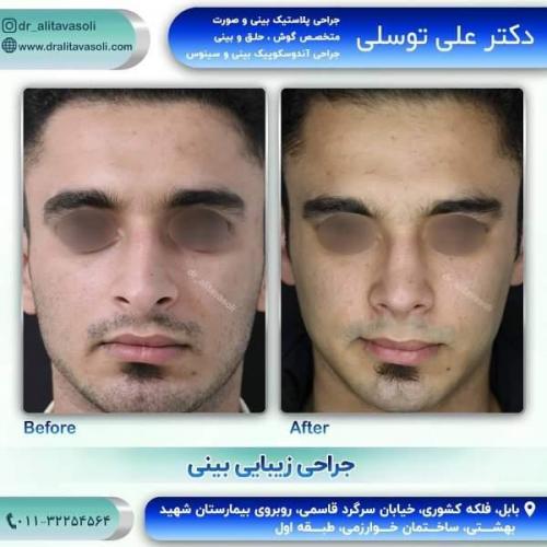 جراحی بینی 150 (35)