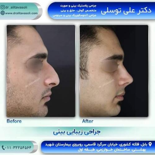جراحی بینی 150 (36)