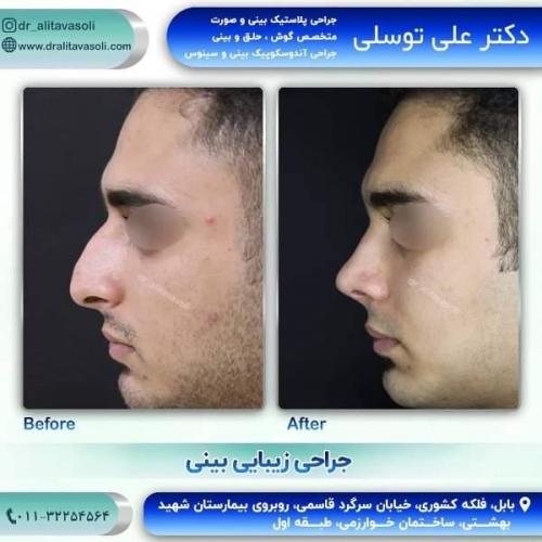 جراحی بینی 150 (37)