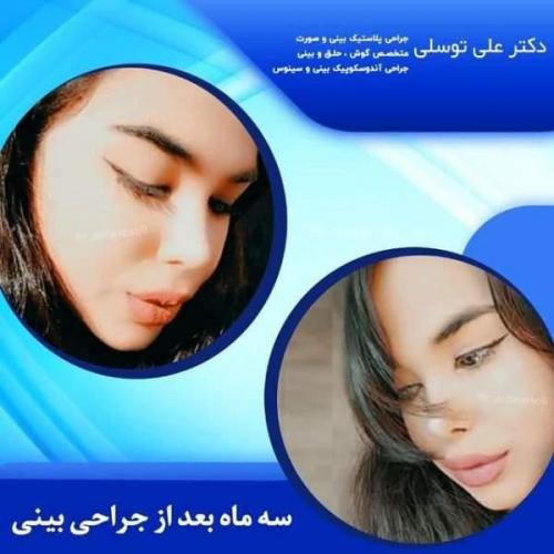 جراحی بینی 150 (38)