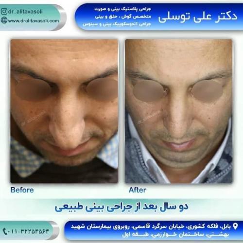 جراحی بینی 150 (46)