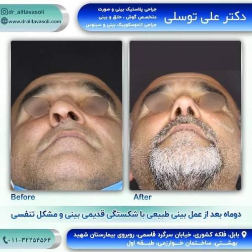 جراحی بینی 150 (51)