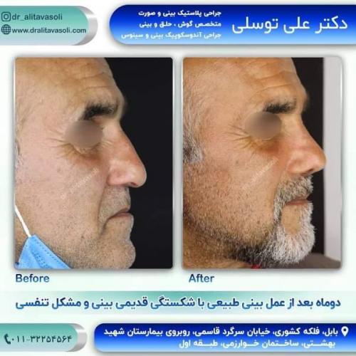 جراحی بینی 150 (52)