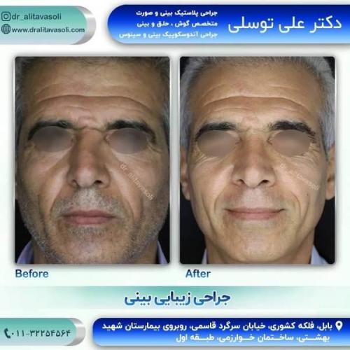 جراحی بینی 150 (53)