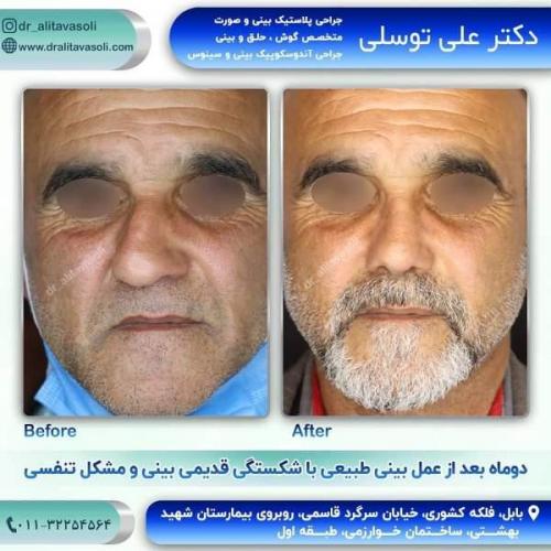 جراحی بینی 150 (55)