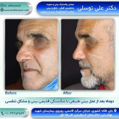 جراحی بینی 150 (56)