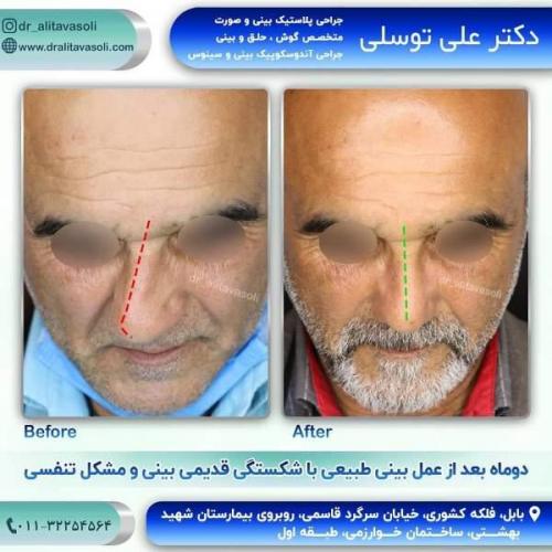 جراحی بینی 150 (57)