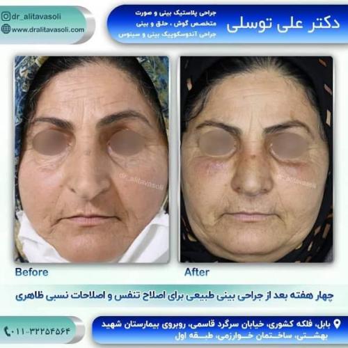 جراحی بینی 150 (58)